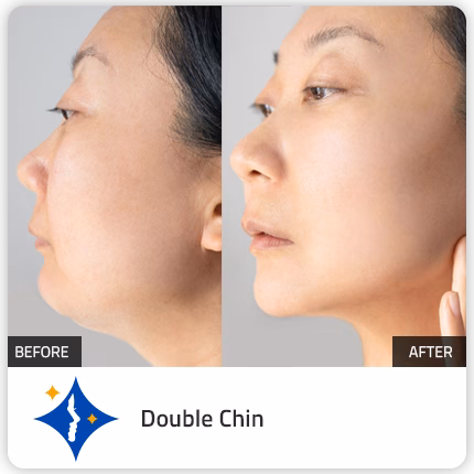 Face contouring at glow dubai before after results