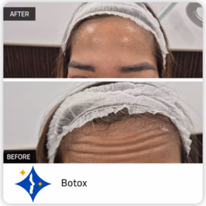 Botox in Dubai: Botulinum Toxin injection dubai for Anti Ageing
