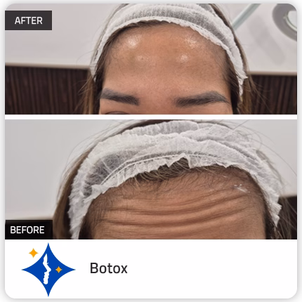 Botox in Dubai: Botulinum Toxin injection dubai for Anti Ageing