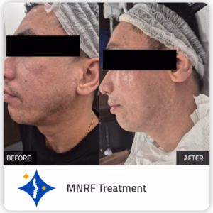 Before after of MNRF in Dubai - Microneedling Radiofrequency