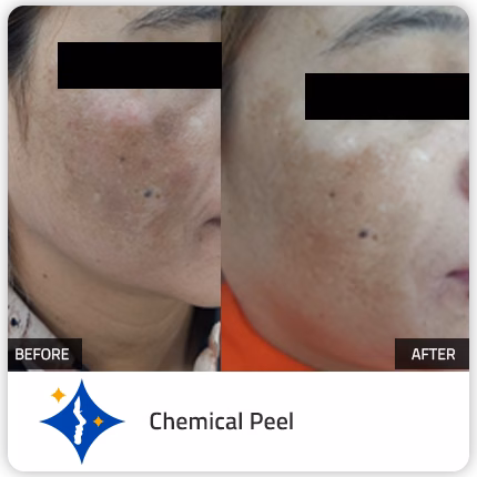 Chemical peel treatment for Hyperpigmentation in dubai
