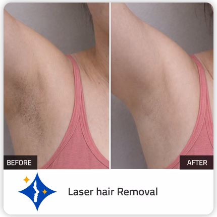 permanent laser hair removal in dubai