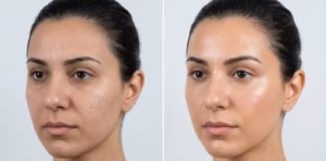 Hydrafacial before after for Acne scar on face e1777885459896