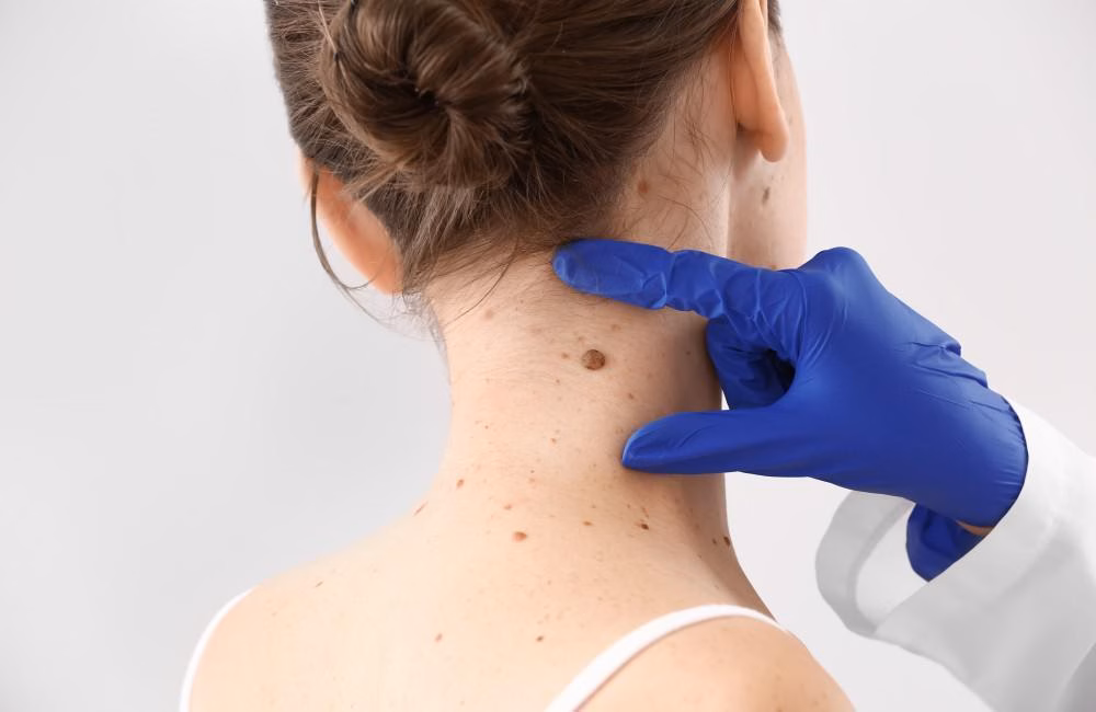 Home 16 skin tag removal on neck