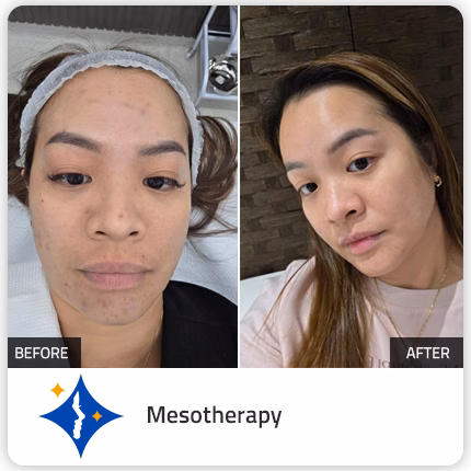 13-Mesotherapy