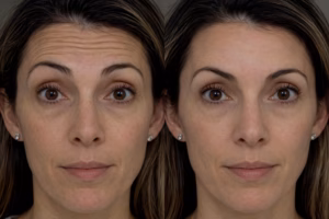 Botox injection before after results