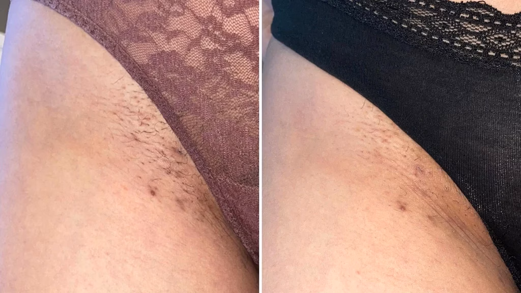Pigmentation on bikini line area
