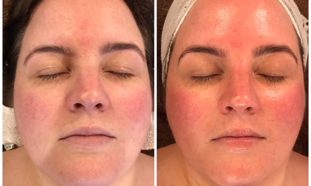 Hydrafacial vs Regular Facial results and comparison