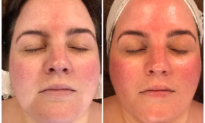 HydraFacial Treatment 2 Hydrafacial vs Regular Facial results and comparison