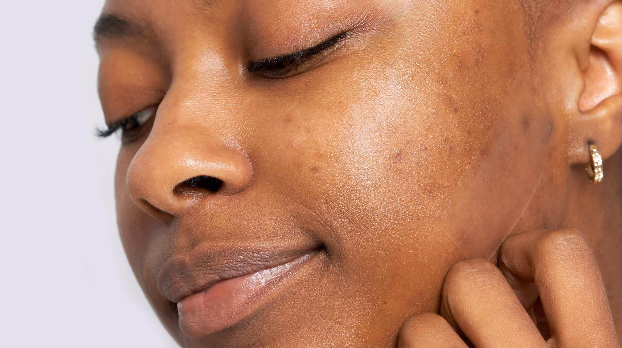 Most Effective Acne Scar Treatments on Darker Skins. 1 Most Effective Acne Scar Treatments on Darker Skins.