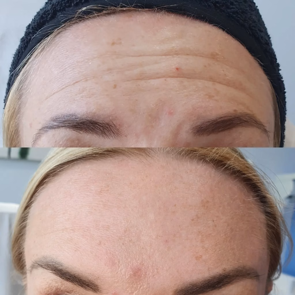 How Long Does Botox Last? Full Face Guide by Dermatologist 2 How Long Does Botox Last On Forehead?