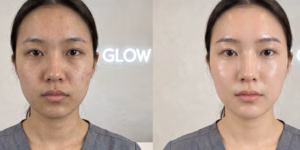 Brightening IV Drip 1 skin brightening drip dubai before after results