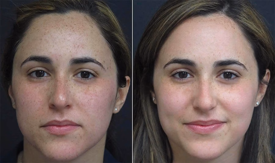 Hydrafacial for face pigmentation Does it really works?