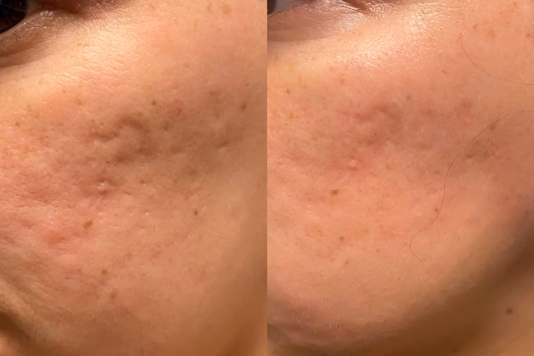 How Microneedling Works on Acne? Basics You Should Know 1 How Microneedling works on acne? Basics you should know