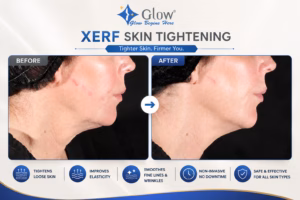 XERF Treatment 3 XERF skin tightening before after results for scar also