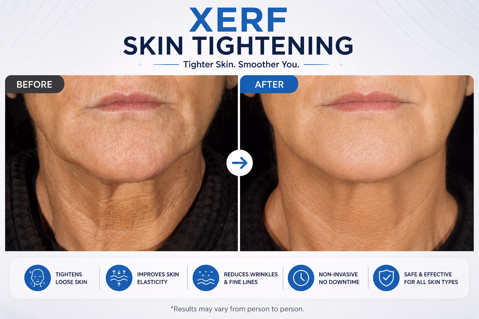 XERF vs Ultherapy: Which Skin Tightening Treatment Is Better for Me? 3 XERF skin tightening before after results